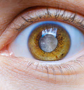 Cataracts